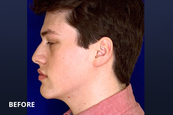 Liquid Rhinoplasty Before and After Pictures Long Island & Manhattan, NY Liquid Rhinoplasty Before and After Pictures Long Island & Manhattan, NY