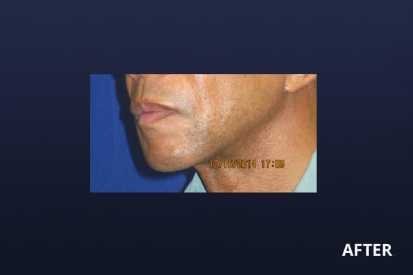 Gentlemen's Services Before and After Pictures Long Island & Manhattan, NY Gentlemen's Services Before and After Pictures Long Island & Manhattan, NY