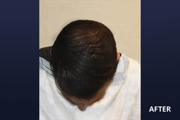 PRP Hair Restoration Before and After Pictures Long Island & Manhattan, NY PRP Hair Restoration Before and After Pictures Long Island & Manhattan, NY