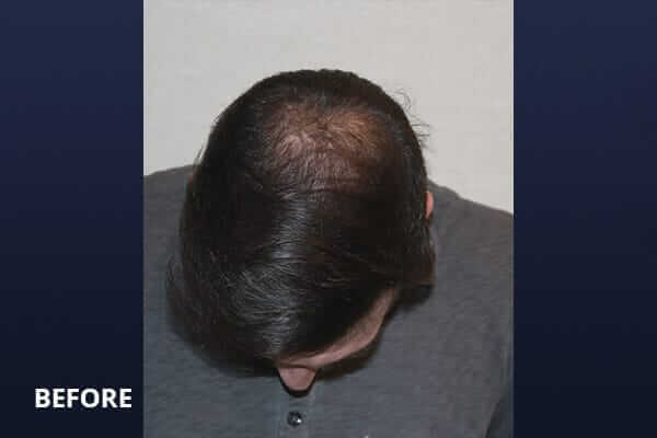 PRP Hair Restoration Before and After Pictures Long Island & Manhattan, NY PRP Hair Restoration Before and After Pictures Long Island & Manhattan, NY
