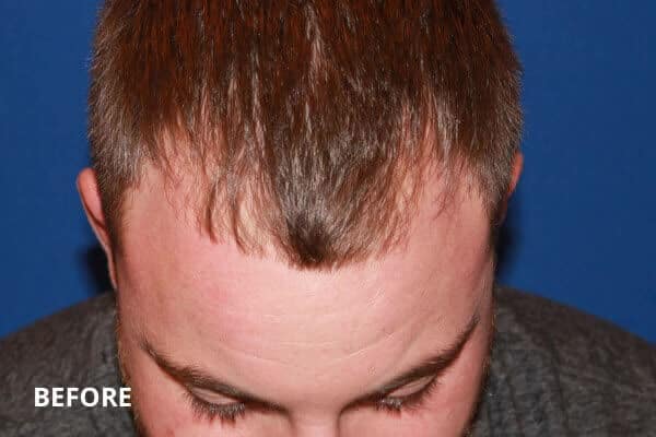 PRP Hair Restoration Before and After Pictures Long Island & Manhattan, NY PRP Hair Restoration Before and After Pictures Long Island & Manhattan, NY