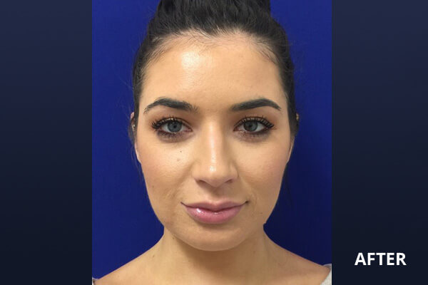 Ultherapy Before and After Pictures Long Island & Manhattan, NY Ultherapy Before and After Pictures Long Island & Manhattan, NY