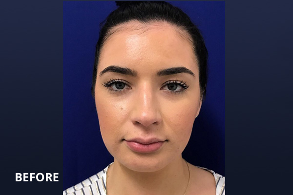 Ultherapy Before and After Pictures Long Island & Manhattan, NY Ultherapy Before and After Pictures Long Island & Manhattan, NY