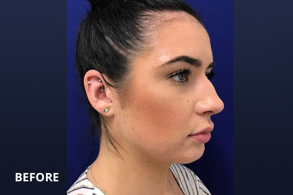 Ultherapy Before and After Pictures Long Island & Manhattan, NY