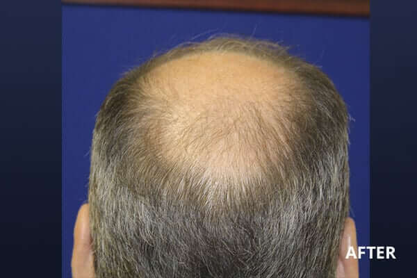 PRP Hair Restoration Before and After Pictures Long Island & Manhattan, NY