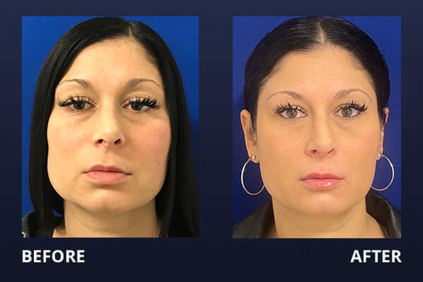 Botox Before and After Pictures Long Island & Manhattan, NY