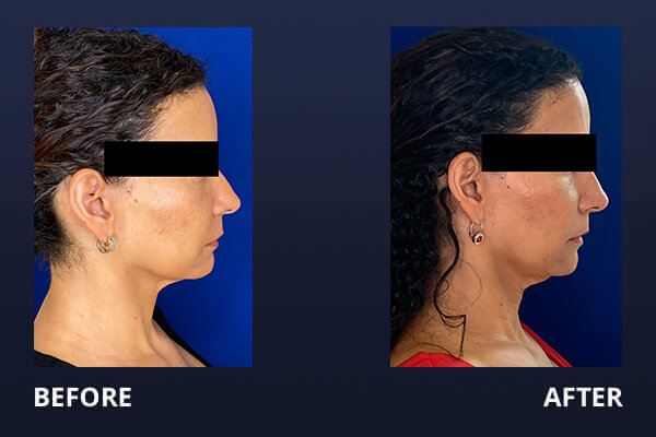 Botox Before and After Pictures Long Island & Manhattan, NY