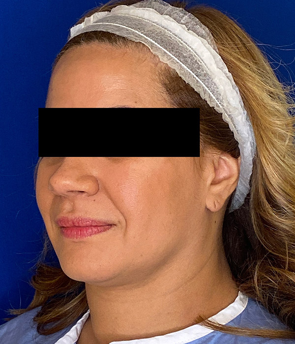 Smartlipo Precision TX Before and After Pictures Long Island & Manhattan, NY