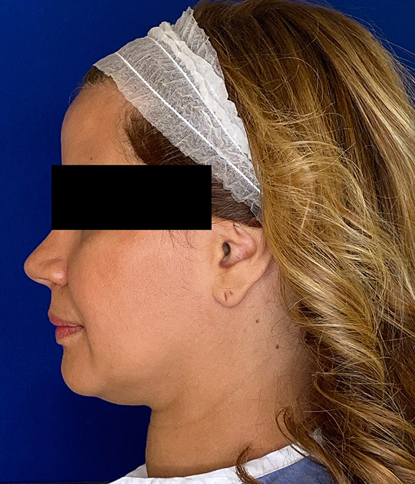 Smartlipo Precision TX Before and After Pictures Long Island & Manhattan, NY