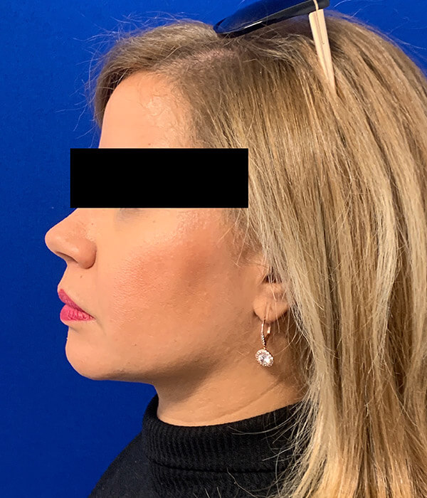 Smartlipo Precision TX Before and After Pictures Long Island & Manhattan, NY