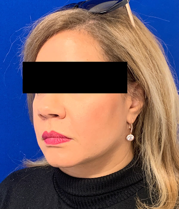 Smartlipo Precision TX Before and After Pictures Long Island & Manhattan, NY