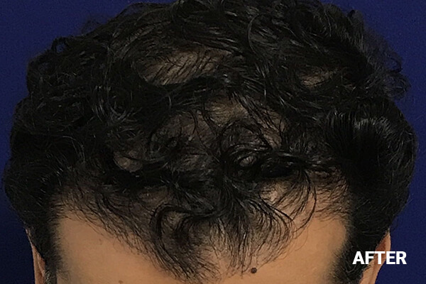 Hair Transplant Before and After Pictures Long Island & Manhattan, NY Hair Transplant Before and After Pictures Long Island & Manhattan, NY