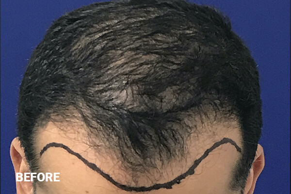 Hair Transplant Before and After Pictures Long Island & Manhattan, NY Hair Transplant Before and After Pictures Long Island & Manhattan, NY