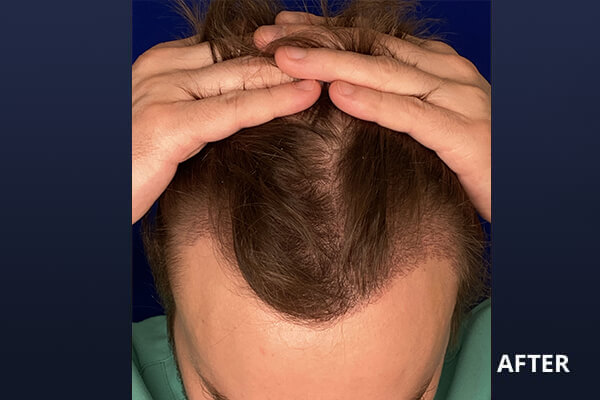 Hair Transplant Before and After Pictures Long Island & Manhattan, NY Hair Transplant Before and After Pictures Long Island & Manhattan, NY
