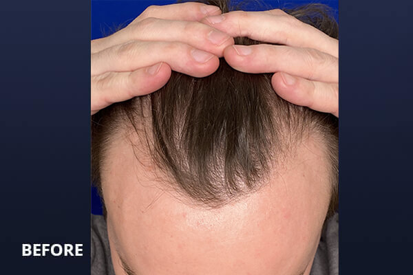 Hair Transplant Before and After Pictures Long Island & Manhattan, NY