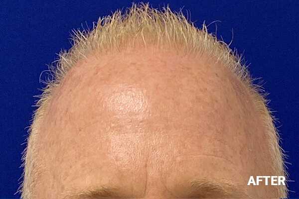 Hair Transplant Before and After Pictures Long Island & Manhattan, NY