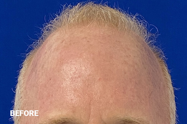 Hair Transplant Before and After Pictures Long Island & Manhattan, NY Hair Transplant Before and After Pictures Long Island & Manhattan, NY