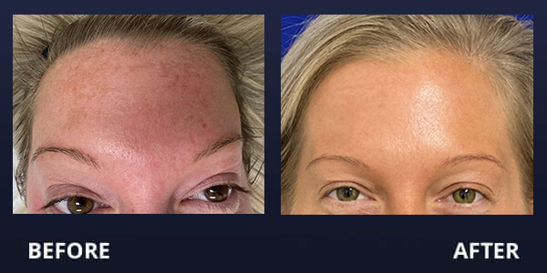Photofacial Before and After Pictures Long Island & Manhattan, NY